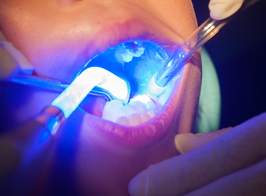 Close up of a child receiving dental sealants