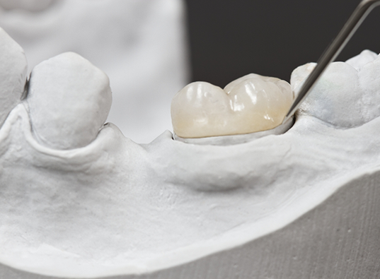 Dental crown covering a tooth in a model of the mouth