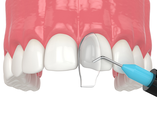 Illustration of bonding material being applied to a chipped front tooth