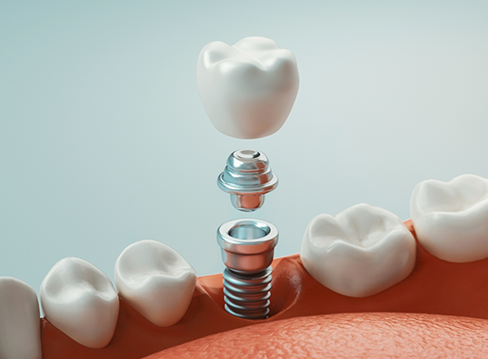 Illustrated dental implant with crown replacing a missing lower tooth