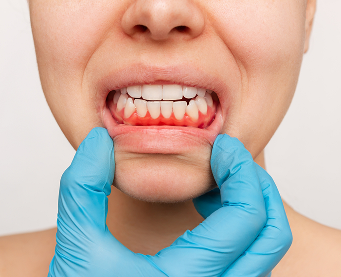 Person pulling down their lower lip to reveal red gums needing gum disease treatment