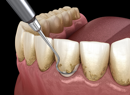 Illustrated dental scaler clearing plaque buildup from teeth and gumline