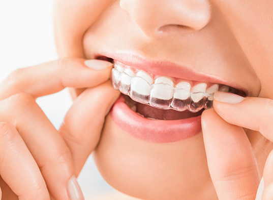 Close up of a person placing an Invisalign aligner over their teeth