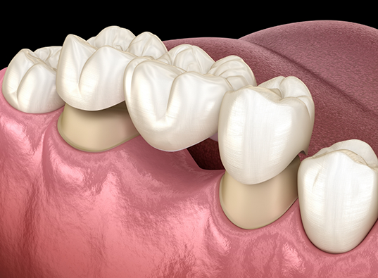 Illustrated dental bridge being attached to two teeth to fill the gap between them