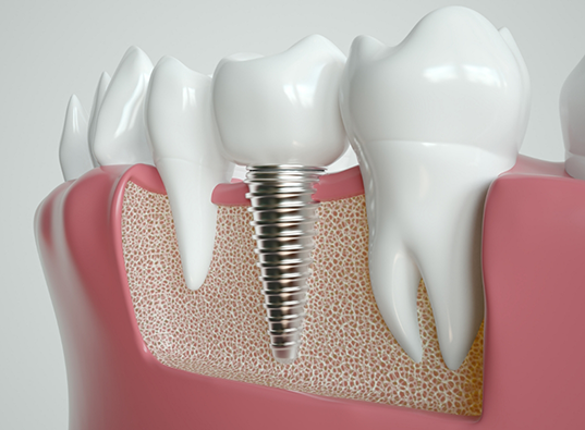 Illustrated dental implant in lower jawbone replacing a missing tooth