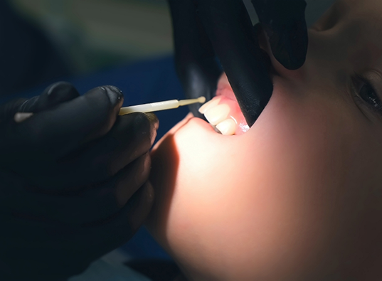 Close up of a dental patient having fluoride applied to their teeth