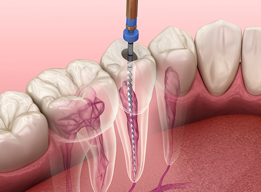 Illustration of a dental instrument treating the inside of a tooth