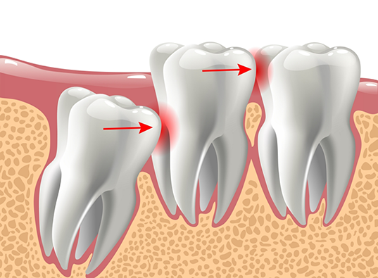 Illustration of an impacted wisdom tooth pushing against the adjacent teeth