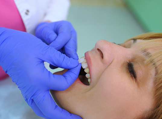 Cosmetic dentist placing a veneer over a patients tooth